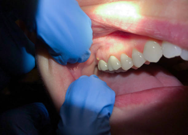 Best Chipped Tooth Repair Near Me  in Gonzales, CA
